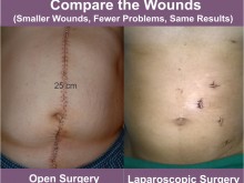 What are the advantages of laparoscopy versus open surgery?